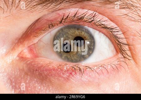 Macro of a man's human eye with double iris, close-up on the two pupils. Congenital eye disease called polycoria characterized by more than one pupill Stock Photo