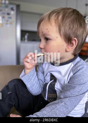 Portrait of little toddler with chickenpox eating cookie Stock Photo