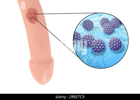 Penile (genital) warts and close-up view of human papilloma virus, computer  illustration. Warts (condyloma acuminata) of the anogenital region are cau  Stock Photo - Alamy