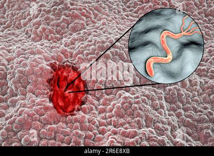 Gastric (stomach) ulcer and close-up view of bacterium Helicobacter pylori, illustration. Gastric, or peptic, ulcers are erosions of the mucosal linin Stock Photo