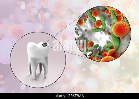 Tooth decay. Computer artwork of a tooth with cavity and close-up view of bacteria which cause caries formation. Stock Photo