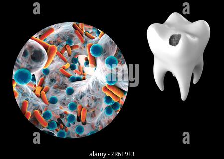 Tooth decay. Computer artwork of a tooth with cavity and close-up view of bacteria which cause caries formation. Stock Photo