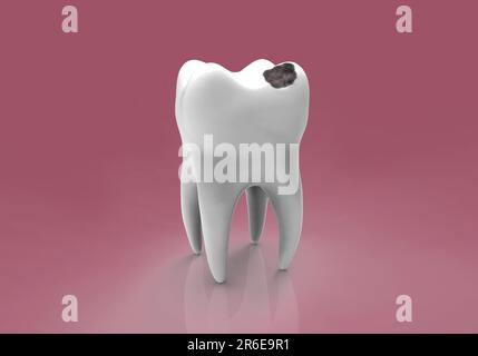 Tooth decay. Computer artwork of a tooth with cavity. Stock Photo