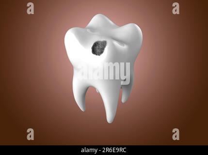 Tooth decay. Computer artwork of a tooth with cavity. Stock Photo