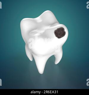 Tooth decay. Computer artwork of a tooth with cavity. Stock Photo