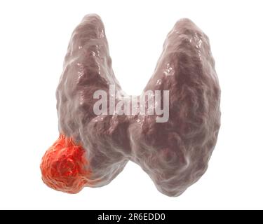 Tumor in human thyroid gland, computer illustration Stock Photo - Alamy