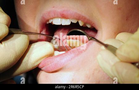 File photo dated 19/05/11 of a dentist at work, as almost 9% of children registered with an NHS dentist have not had a check-up in the last five years, data given to the Scottish Liberal Democrats shows. Stock Photo