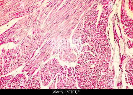 Heart hypertrophy. Photomicrograph showing hypertrophic myocardium with thick muscle fibers and enlarged and dark nuclei Stock Photo