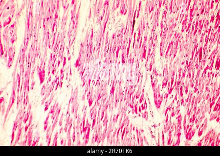 Heart hypertrophy. Photomicrograph showing hypertrophic myocardium with thick muscle fibers and enlarged and dark nuclei Stock Photo