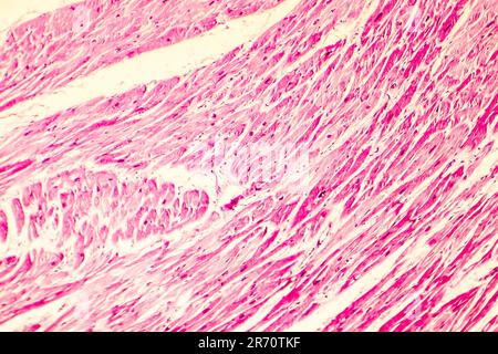 Heart hypertrophy. Photomicrograph showing hypertrophic myocardium with thick muscle fibers and enlarged and dark nuclei Stock Photo