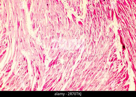 Heart hypertrophy. Photomicrograph showing hypertrophic myocardium with thick muscle fibers and enlarged and dark nuclei Stock Photo