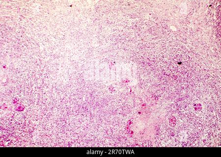 Liquefactive necrosis of the human brain, light photomicrograph showing loss of cell outlines, accumulation of cellular debris, macrophage infiltratio Stock Photo