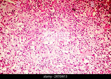 Liquefactive necrosis of the human brain, light photomicrograph showing loss of cell outlines, accumulation of cellular debris, macrophage infiltratio Stock Photo