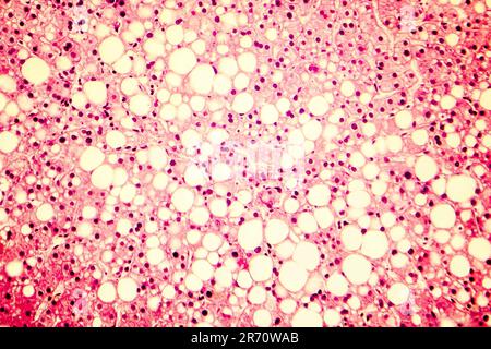 Fatty liver, liver steatosis. Photomicrograph showing large vacuoles of triglyceride fat accumulated inside liver cells, it occurs in alcohol overuse, Stock Photo