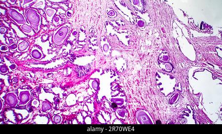 Histopathology of prostate gland hyperplasia, light micrograph, photo ...