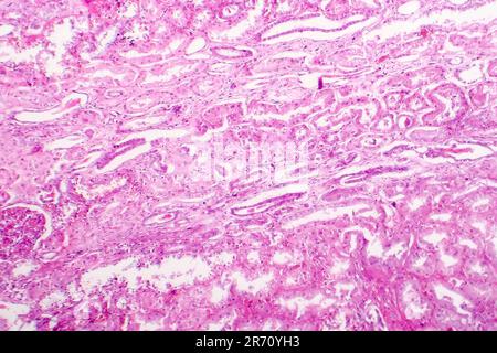 Edema of renal tubular epithelial cells in kidney failure, light ...