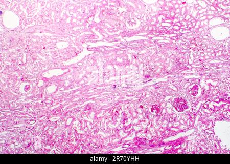 Edema of renal tubular epithelial cells in kidney failure, light ...