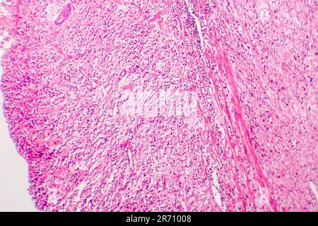 Signet ring cell carcinoma of the stomach, light micrograph, photo ...