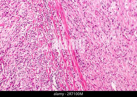 Signet ring cell carcinoma of the stomach, light micrograph, photo ...