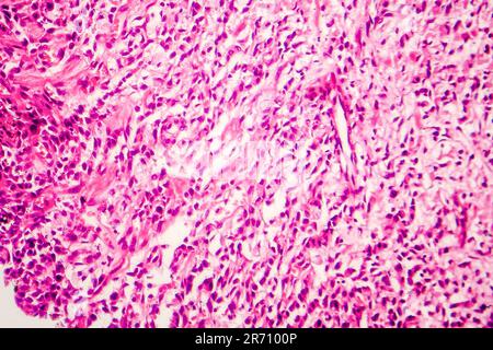 Signet ring cell carcinoma of the stomach, light micrograph, photo ...