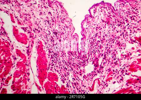 Signet ring cell carcinoma of the stomach, light micrograph, photo ...