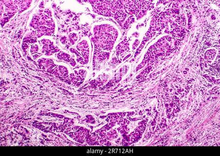 Lymph node metastasis, light micrograph of cancer that has spread to a ...