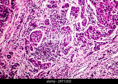 Lymph node metastasis, light micrograph of cancer that has spread to a ...