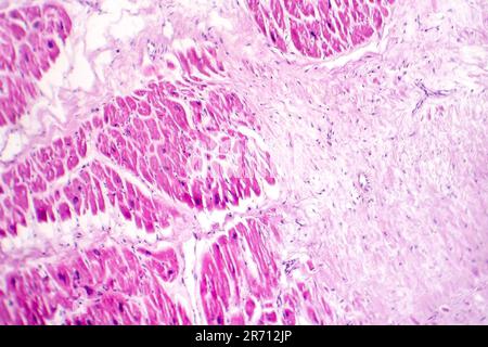 Acute myocardial infarction, histology of heart tissue, light ...