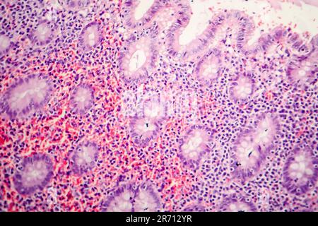 Histopathology of chronic appendicitis, light micrograph, photo under microscope Stock Photo