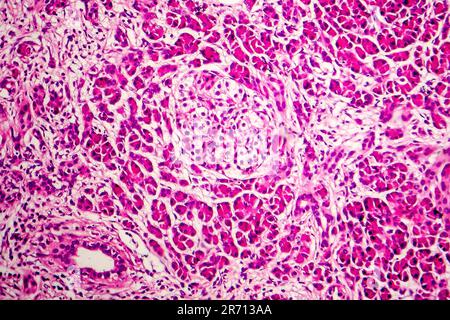 Acute hemorrhagic pancreatitis, light micrograph, hematoxylin and eosin staining Stock Photo
