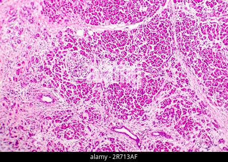Acute hemorrhagic pancreatitis, light micrograph, hematoxylin and eosin staining Stock Photo