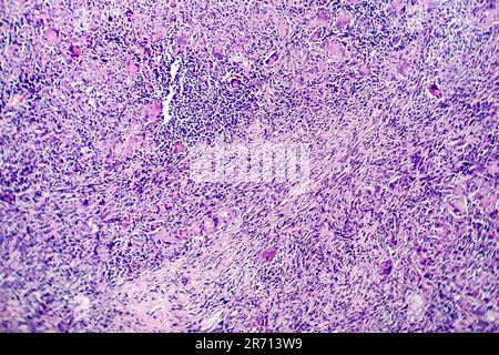 Histopathology of tuberculosis, light micrograph of tuberculosis lesion, photo under microscope Stock Photo