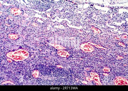 Histopathology of tuberculosis, light micrograph of tuberculosis lesion, photo under microscope Stock Photo