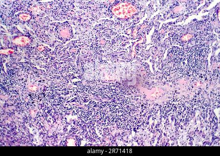 Histopathology of tuberculosis, light micrograph of tuberculosis lesion, photo under microscope Stock Photo