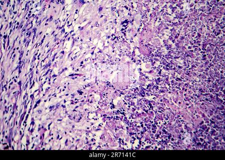 Histopathology of tuberculosis, light micrograph of tuberculosis lesion, photo under microscope Stock Photo