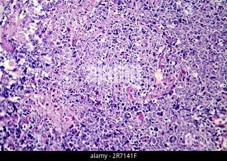 Histopathology of tuberculosis, light micrograph of tuberculosis lesion, photo under microscope Stock Photo