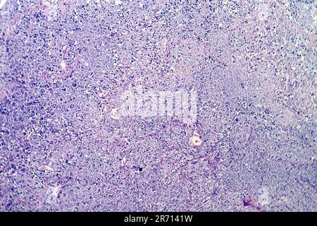 Histopathology of tuberculosis, light micrograph of tuberculosis lesion, photo under microscope at low magnification Stock Photo