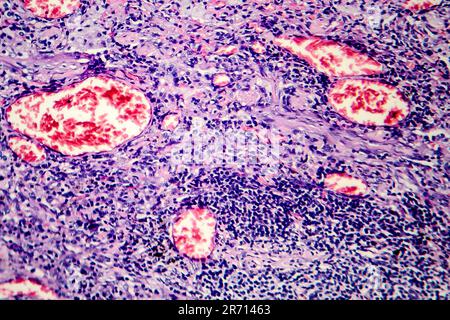 Histopathology of tuberculosis, light micrograph of tuberculosis lesion, photo under microscope Stock Photo