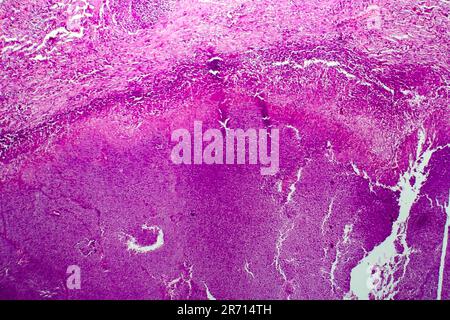 Caseation of human tuberculosis granuloma, light micrograph, photo under microscope. Caseous necrosis, necrotizing granulomatous inflammation Stock Photo