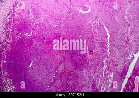 Caseation of human tuberculosis granuloma, light micrograph, photo under microscope. Caseous necrosis, necrotizing granulomatous inflammation Stock Photo