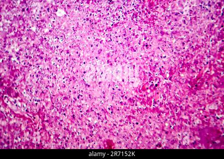 Caseation of human tuberculosis granuloma, light micrograph, photo under microscope. Caseous necrosis, necrotizing granulomatous inflammation Stock Photo