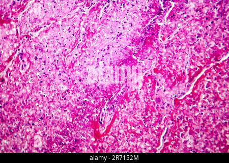 Caseation of human tuberculosis granuloma, light micrograph, photo under microscope. Caseous necrosis, necrotizing granulomatous inflammation Stock Photo