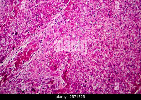 Caseation of human tuberculosis granuloma, light micrograph, photo under microscope. Caseous necrosis, necrotizing granulomatous inflammation Stock Photo