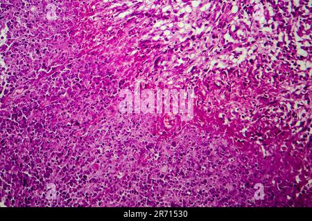 Caseation of human tuberculosis granuloma, light micrograph, photo under microscope. Caseous necrosis, necrotizing granulomatous inflammation Stock Photo