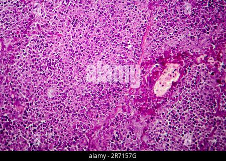 Caseation of human tuberculosis granuloma, light micrograph, photo under microscope. Caseous necrosis, necrotizing granulomatous inflammation Stock Photo