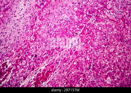 Caseation of human tuberculosis granuloma, light micrograph, photo under microscope. Caseous necrosis, necrotizing granulomatous inflammation Stock Photo