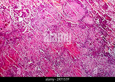 Miliary tuberculosis, light micrograph, photo under microscope Stock Photo