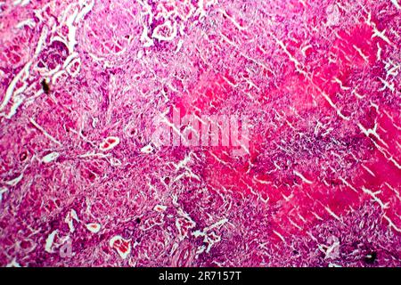 Miliary tuberculosis, light micrograph, photo under microscope Stock Photo