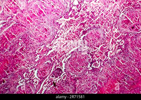 Miliary tuberculosis, light micrograph, photo under microscope Stock Photo