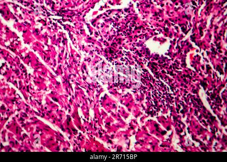 Miliary tuberculosis, light micrograph, photo under microscope Stock Photo